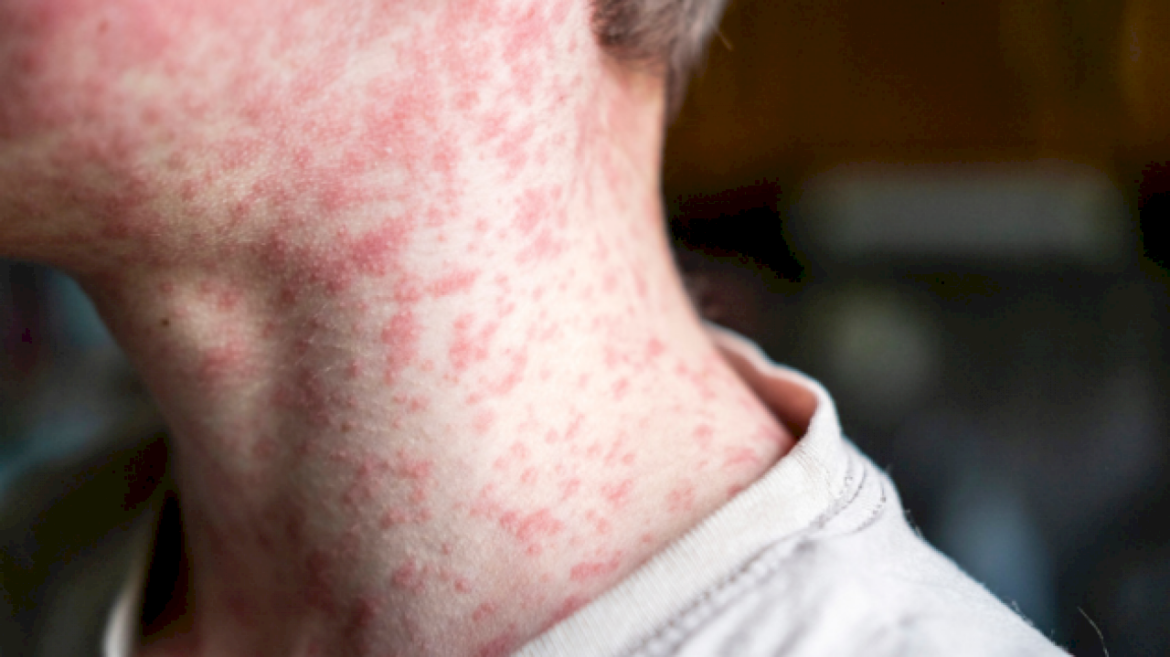 what-to-know-about-measles