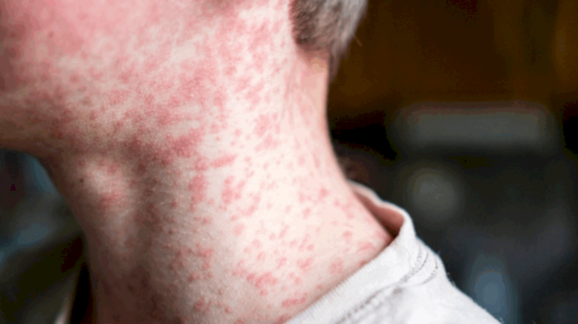 1st-measles-case-of-the-year-in-south-dakota-as-cdc-updates-travel-guidance