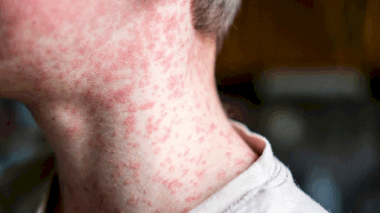1st-measles-case-of-the-year-in-south-dakota-as-cdc-updates-travel-guidance