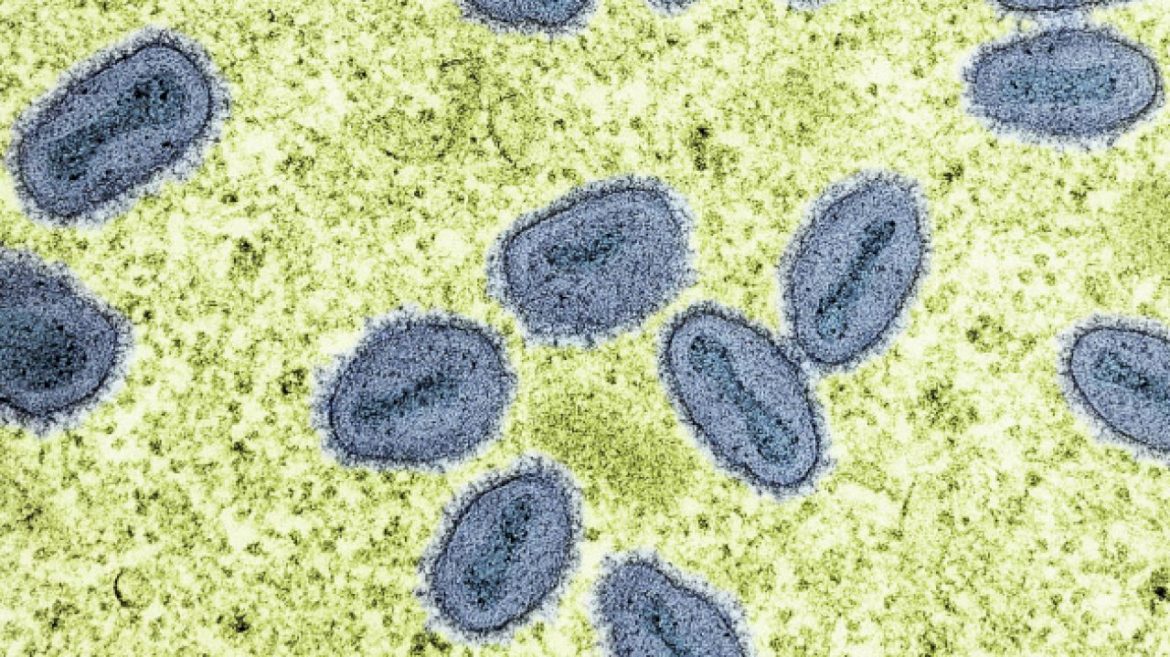 california-officials-confirm-1st-us-case-of-severe-mpox-strain-with-no-travel-history