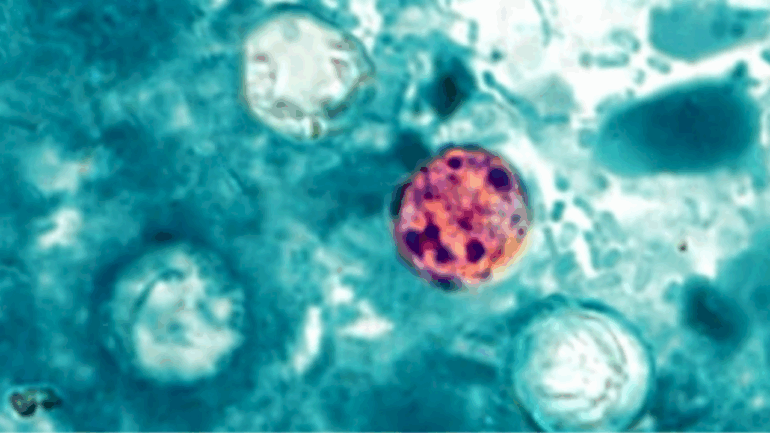 ‘large-and-growing’-parasitic-infection-outbreak-spreading-in-michigan,-health-officials-say