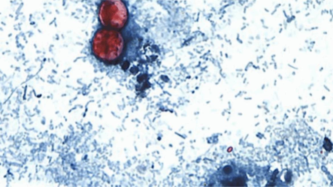 federal-health-officials-have-investigated-5-different-clusters-of-cyclosporiasis-cases,-fda-says